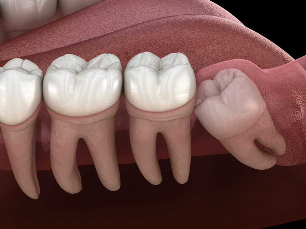 graphic of a wisdom tooth coming in